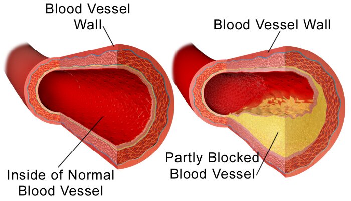 New medical techniques can detect Early Stages of Artery Deposits